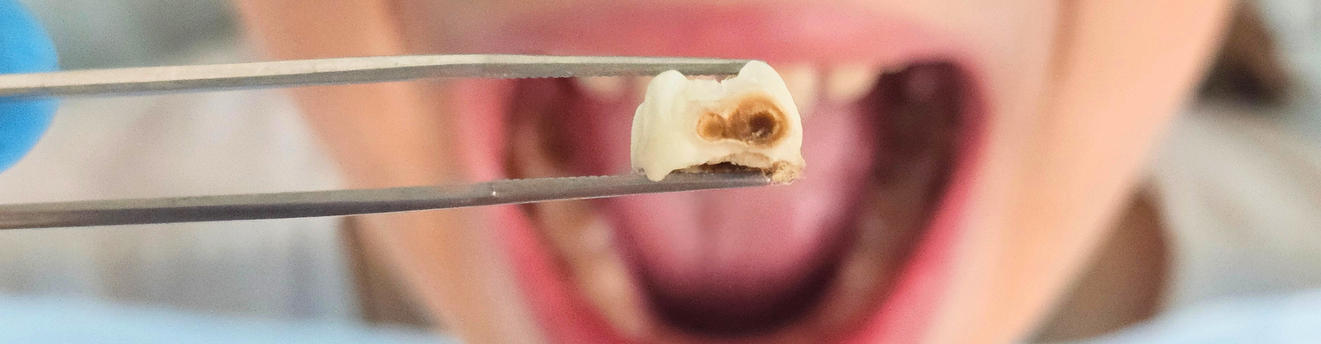 Tweezers holding a tooth with a cavity in front of a child's mouth.